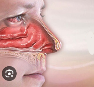 Allergic Rhinitis