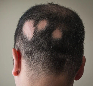 Alopecia