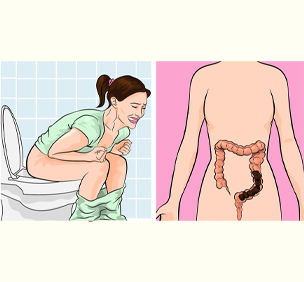 Constipation