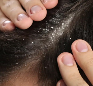 Dandruff