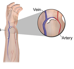Fistula