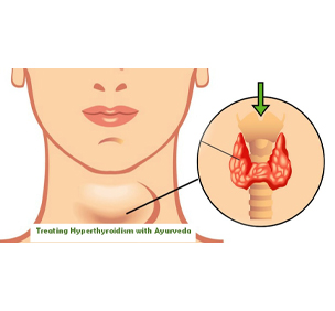 Hyperthyroidism