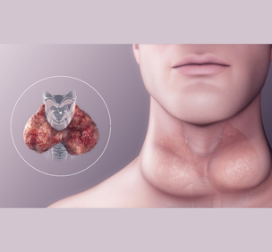 Hypothyroidism