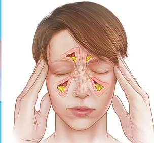 Sinusitis