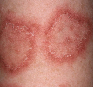 Skin Diseases