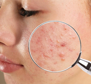 Acne Pimples