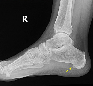 Calcaneum Spur