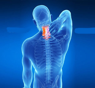 Cervical Spondylosis