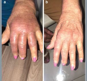 Viral Arthritis