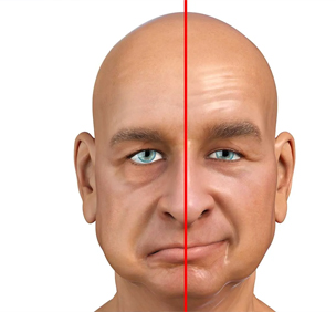 Facial Palsy