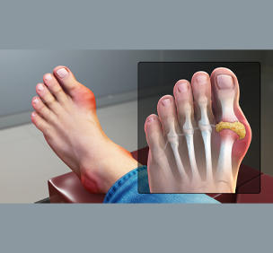 Gout