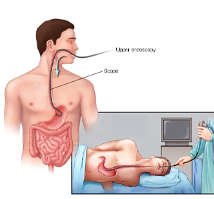 Hiatus Hernia