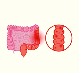 IBS / Colitis