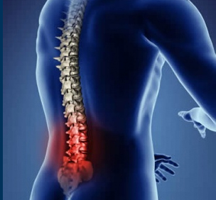Lumbar Spondylosis