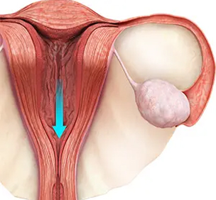 Menstrual Disorders