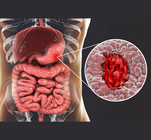 Peptic Ulcer