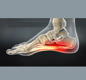 Plantar Fasciatis