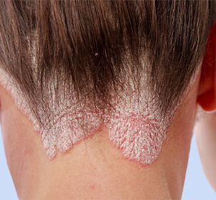 Psoriasis