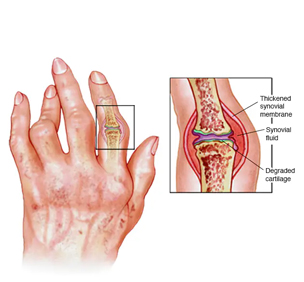 Rheumatoid Arthritis