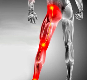 Sciatica