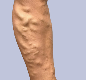 Varicose Veins